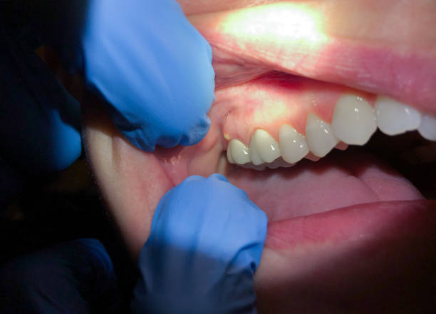 Best Emergency Broken Tooth Repair in Aberdeen, ID